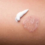 Fungal Infection on Skin in Women and Men